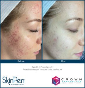 Skinpen Before and After Treatment | Bradenton Aesthetics in Florida