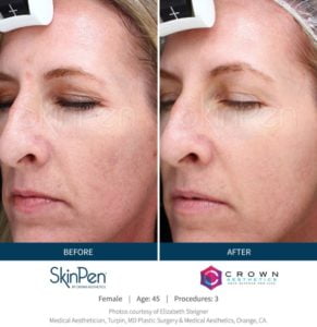 Skinpen Before and After Treatment | Bradenton Aesthetics in Florida