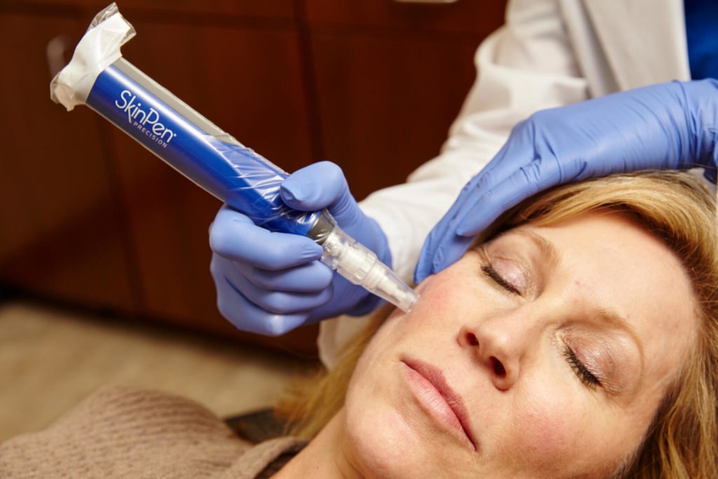 A Woman Getting SkinPen Microneedling treatment | Best Medical Spa in Bradenton, FL | Bradenton Aesthetics