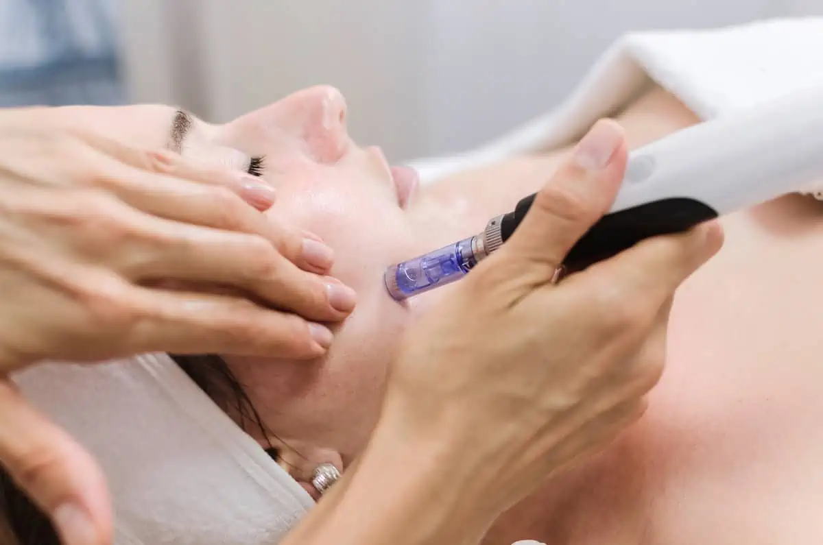 Discover the Magic of SkinPen Microneedling